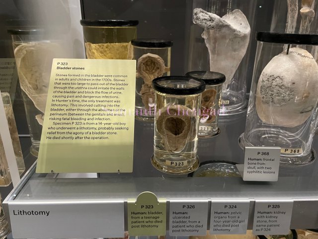 Bladder stones